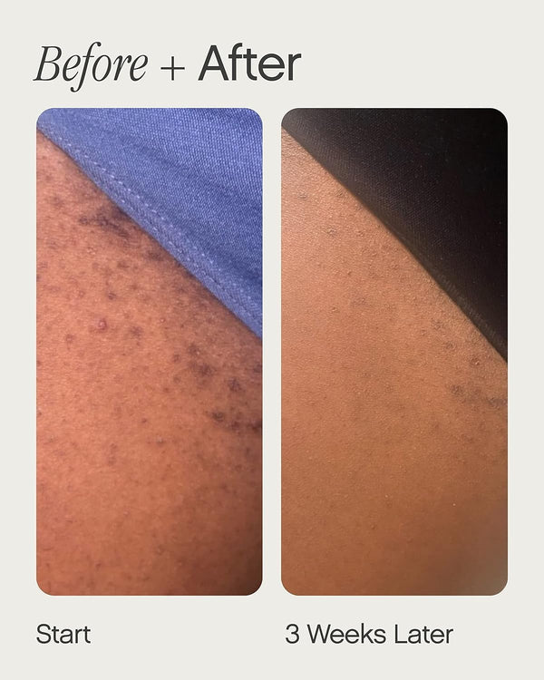 Smooth Skin Ingrown Hair Solution